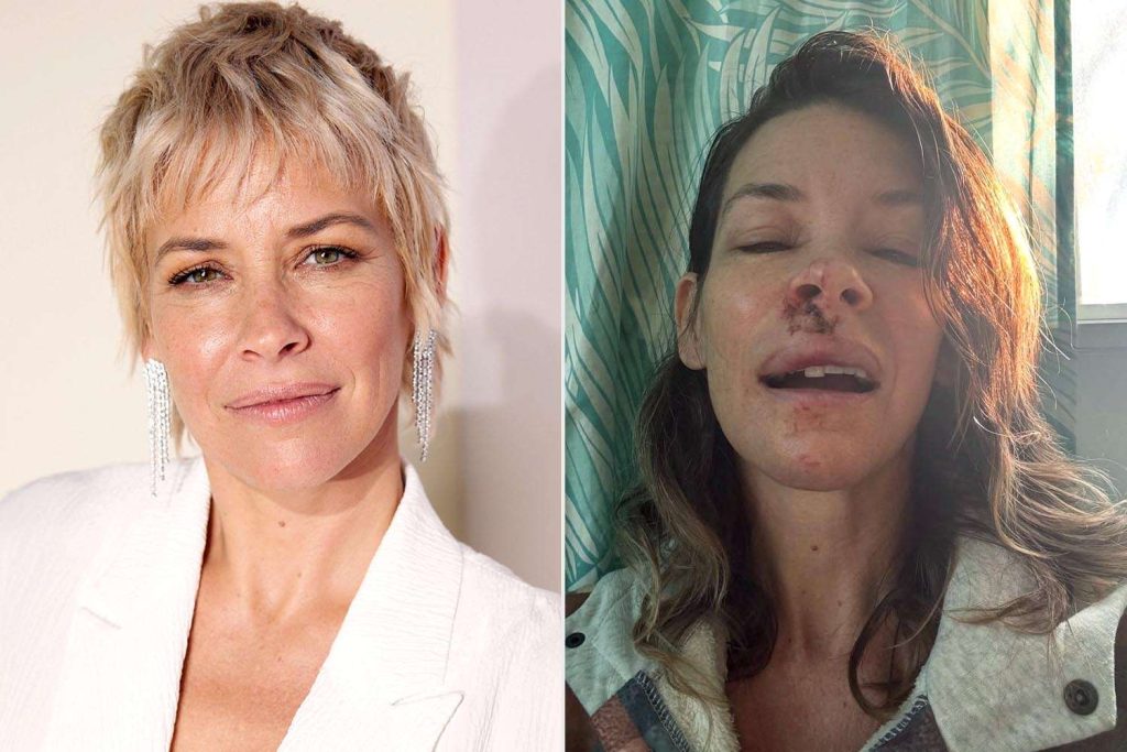 Evangeline Lilly a dezvăluit că suferă de leziuni cerebrale Actrița Evangeline Lilly a anunțat recent că suferă de leziuni cerebrale ca urmare a unei concuzii suferite în mai 2023