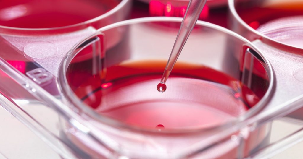 Un nou pas în lupta împotriva leucemiei mieloide acute: cercetări promițătoare asupra semnalelor celulare Un studiu recent aduce speranțe în domeniul tratamentelor pentru leucemia mieloide acute, una dintre cele mai agresive și dificil de tratat forme de cancer hematologic