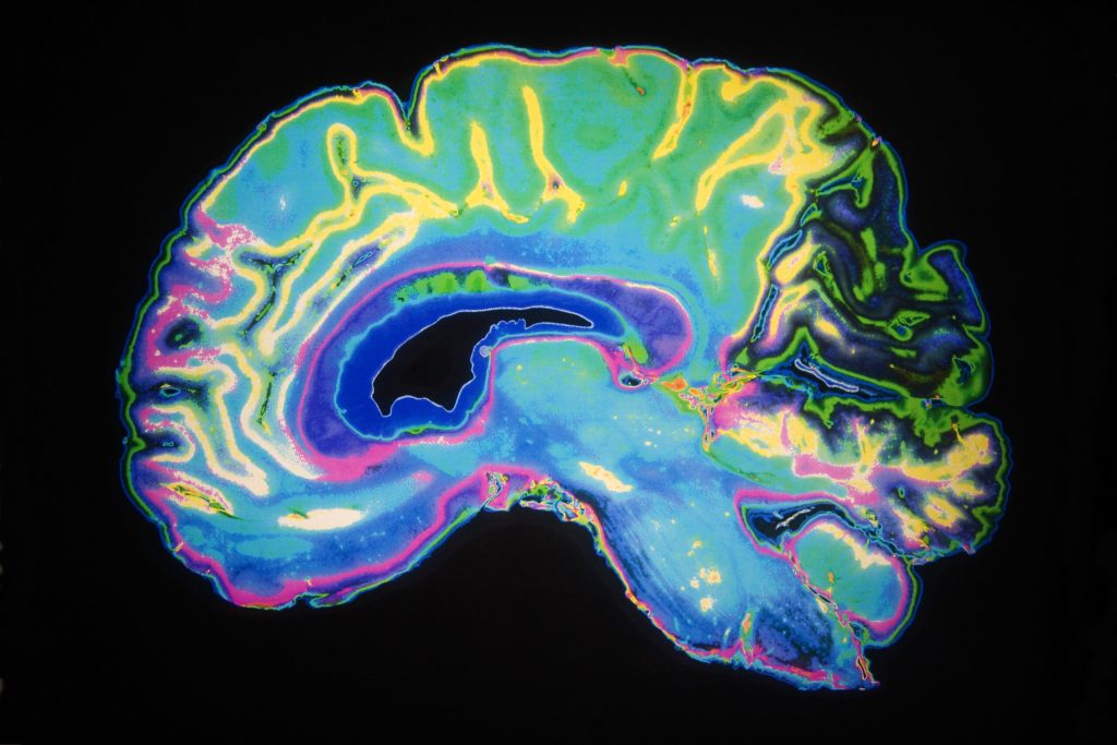 Descoperire revoluționară în lupta contra bolii Alzheimer: celulele cerebrale au arme secrete împotriva proteinei toxice tau Cercetări recente realizate de oamenii de știință de la UCLA Health și UC San Francisco deschid noi perspective în combaterea bolii Alzheimer, una dintre cele mai devastatoare și mai dificile provocări ale medicinei moderne