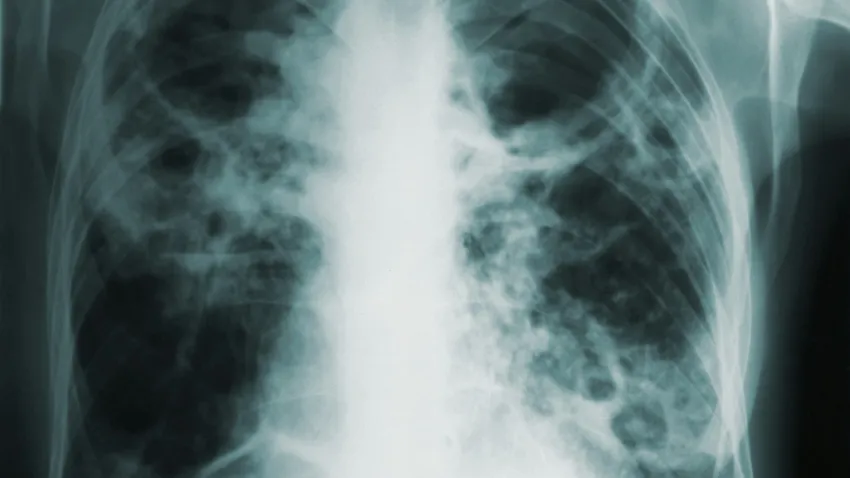 De ziua mondială de Luptă Împotriva Tuberculozei, România marchează un moment de conștientizare cu o acțiune simbolică menită să atragă atenția asupra acestei boli încă periculoase