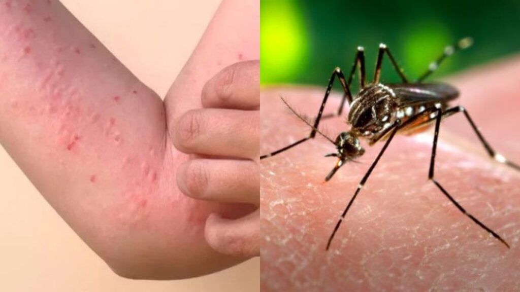 Cazurile de chikungunya înregistrează o creștere alarmantă în Europa, punând autoritățile în alertă în contextul în care virusul tropical amenință să se extindă în zone turistice de pe continent