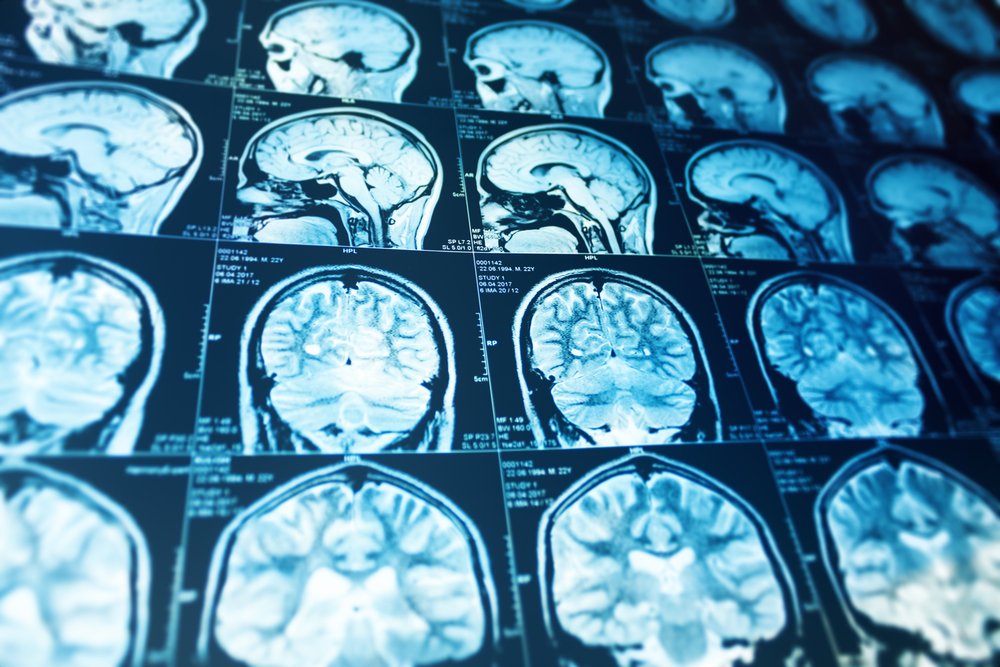O întrebare tot mai intens dezbătută în domeniul medical, în special în ultimele ani, se referă la posibilele legături între grupa de sânge și riscul de accident vascular cerebral (AVC), în special în cazul persoanelor tinere