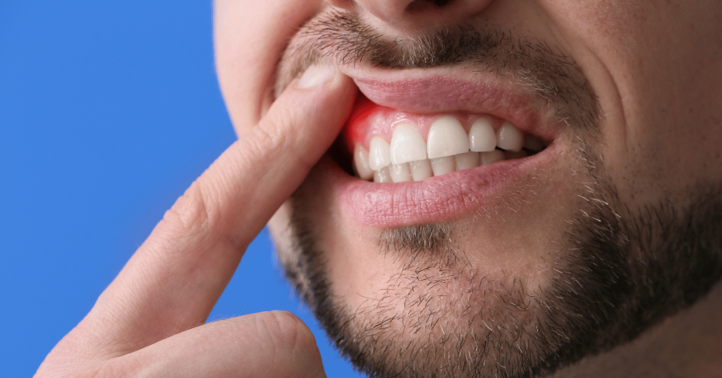 Gingii sângerânde, respirație urât mirositoare și o peliculă albicioasă pe limbă – aceste simptome aparent banale pot fi semne ale unor dezechilibre bacteriene în cavitatea bucală, însă cercetările recente relevă că pot indica, de asemenea, riscuri mai mari pentru sănătatea generală, inclusiv pentru dezvoltarea cancerului colorectal