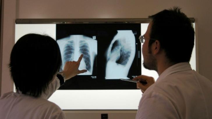 Tuberculoza, o amenințare încă prezentă în România și la nivel global În vreme ce România reușește să mențină rata de incidență a tuberculozei aproape constantă, cu 44,3 cazuri la 100.000 de locuitori, problema rămâne de domeniul publicului și al sistemului de sănătate