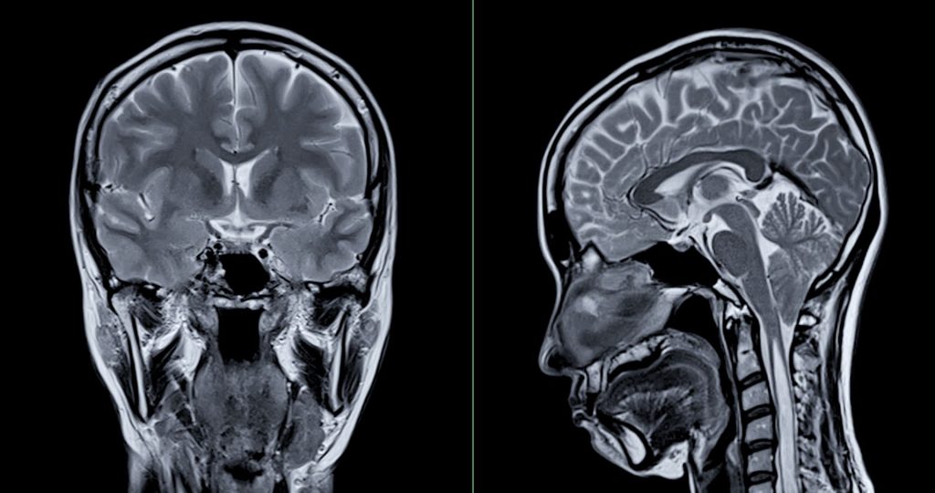 O poveste aproape incredibilă despre sănătate mentală și misterele minții a ieșit recent la lumină, relevând complexitatea legăturii dintre corp și minte în cazul unei femei care, la aproape 40 de ani, a început să audă voci care i-au salvat viața