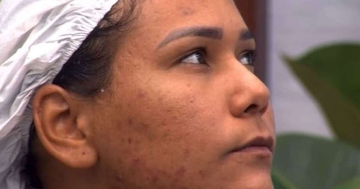 Chaiany Andrade, o fostă concurentă a emisiunii „Big Brother Brasil 26”, a atras atenția publicului asupra unei probleme comune: acneea