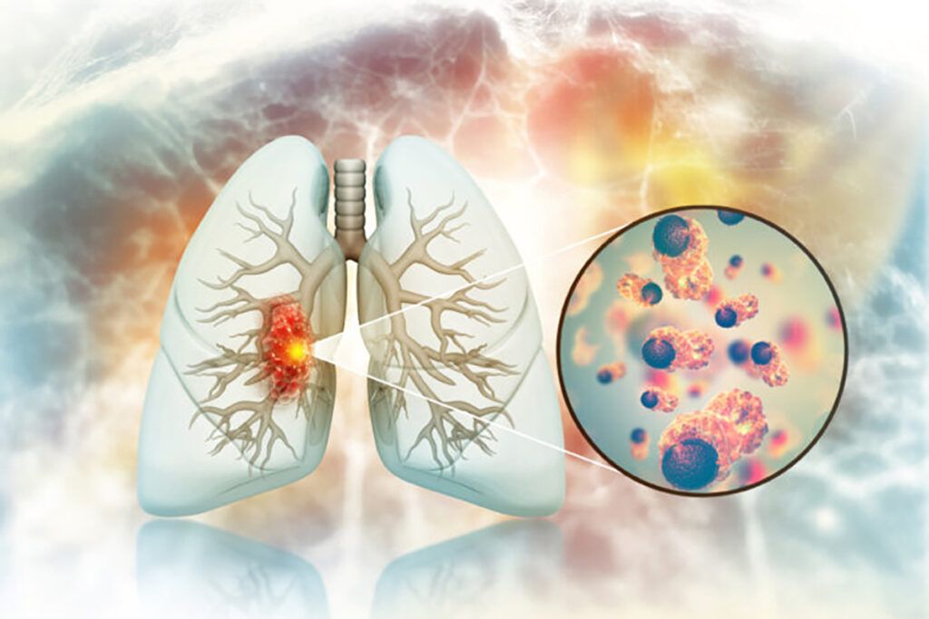 Cancerul pulmonar la nefumători: Legătură ȘOCANTĂ cu fructe și legume