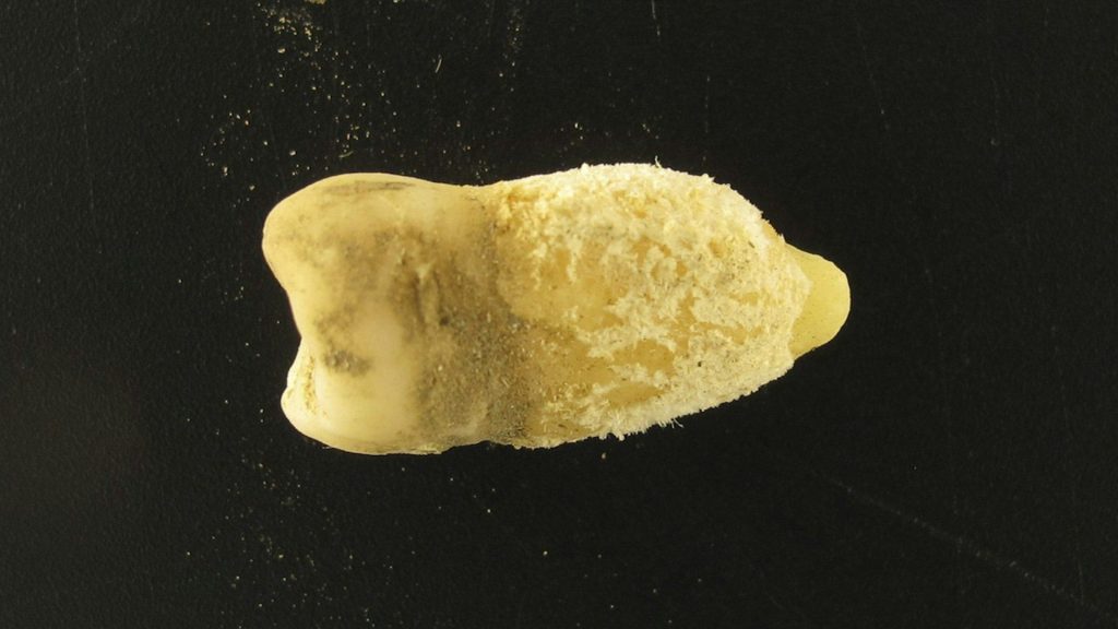 Bacterii de scarlatină, găsite într-o mumie! Descoperirea uimește lumea