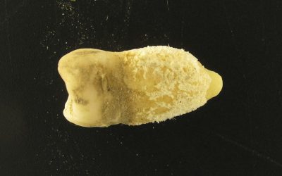 Bacterii de scarlatină, găsite într-o mumie! Descoperirea uimește lumea