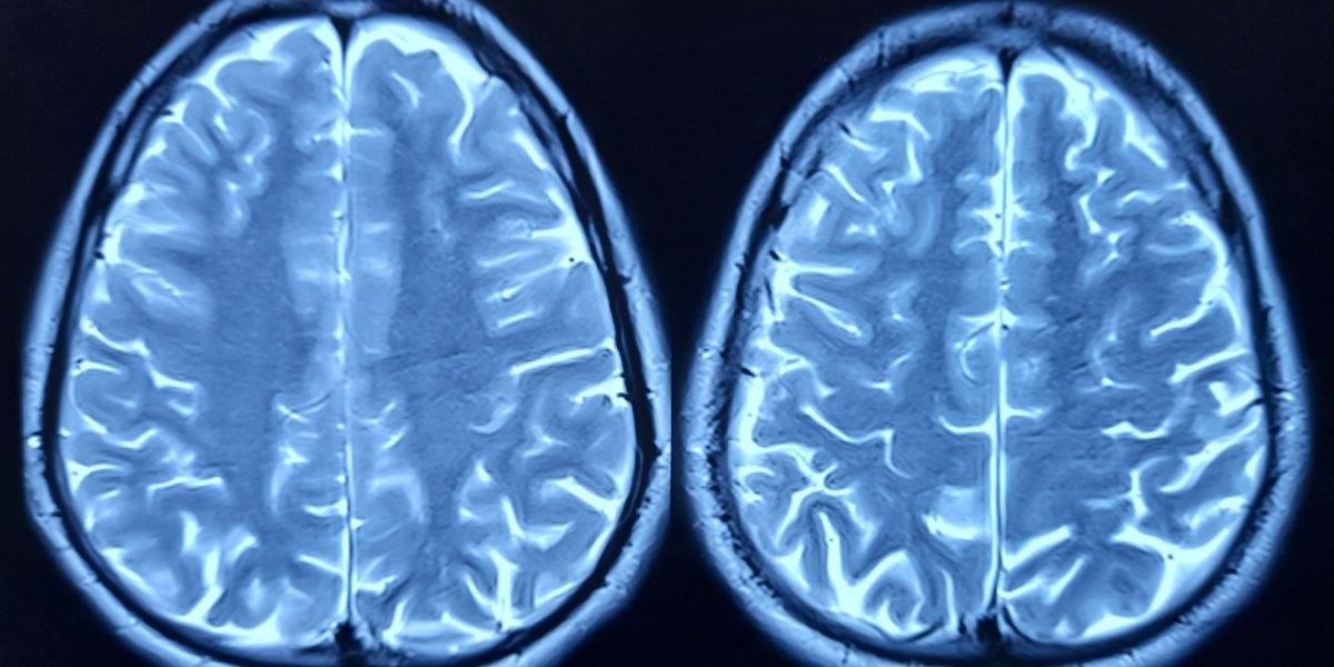 Cercetătorii au identificat factorii care grăbesc îmbătrânirea creierului