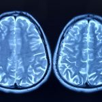 Cercetătorii au identificat factorii care grăbesc îmbătrânirea creierului