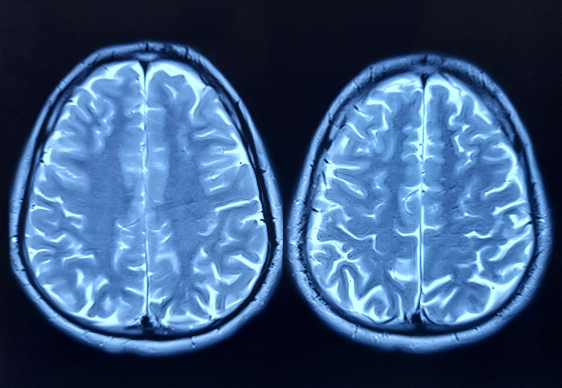 Cercetare revoluționară: o proteină aparent simplă poate influența îmbătrânirea creierului Un nou studiu publicat recent dezvăluie o conexiune surprinzătoare între o proteină numită FTL1 și procesul de îmbătrânire a creierului