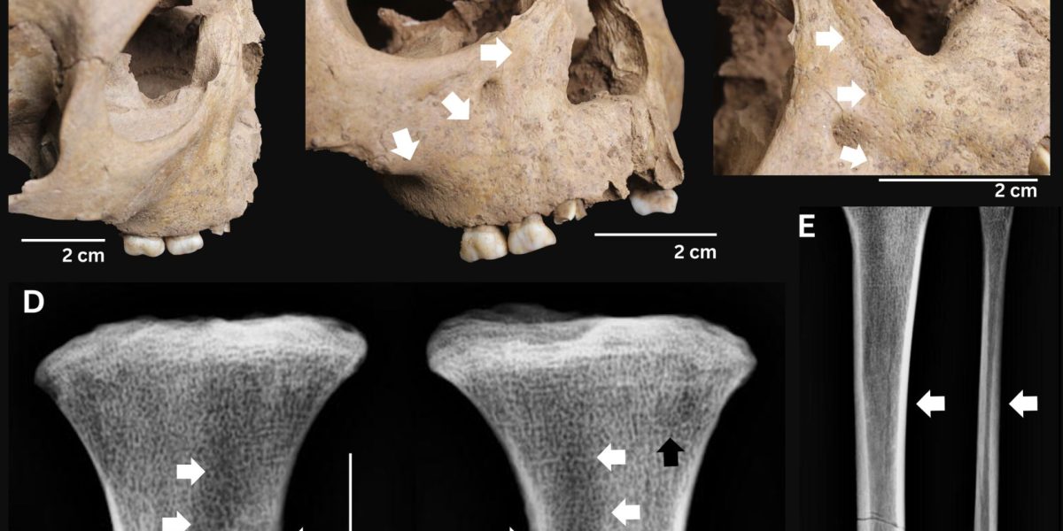Dinții de antici ai copiilor dezvăluie o boală gravă de acum 4.000 de ani