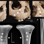 Dinții de antici ai copiilor dezvăluie o boală gravă de acum 4.000 de ani