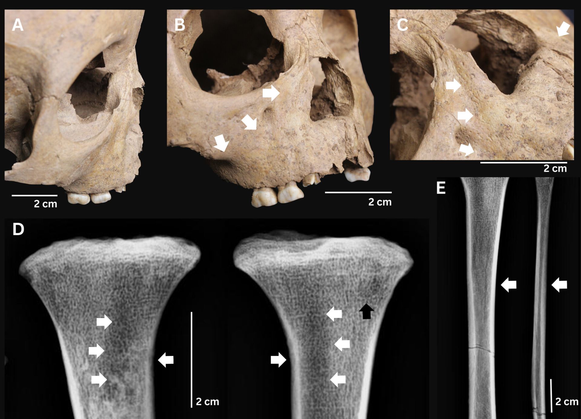 Arheologii din Vietnam au făcut o descoperire care poate schimba înțelegerile legate de originile sifilisului