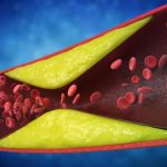 Semnale alarmante: 7 semne că arterele sunt blocate, ignorate de mulți