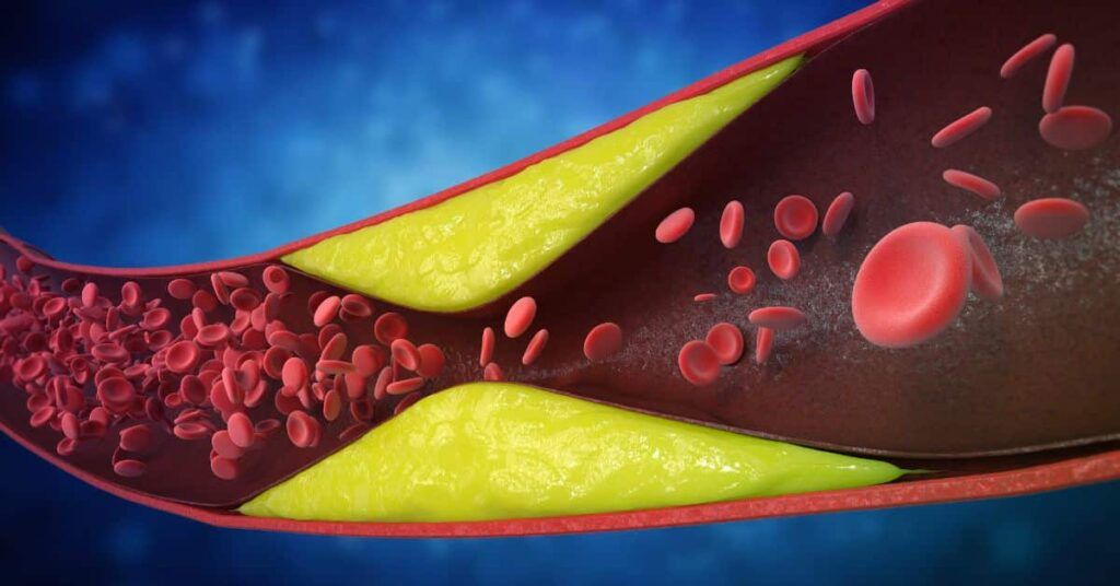 Semnale alarmante: 7 semne că arterele sunt blocate, ignorate de mulți