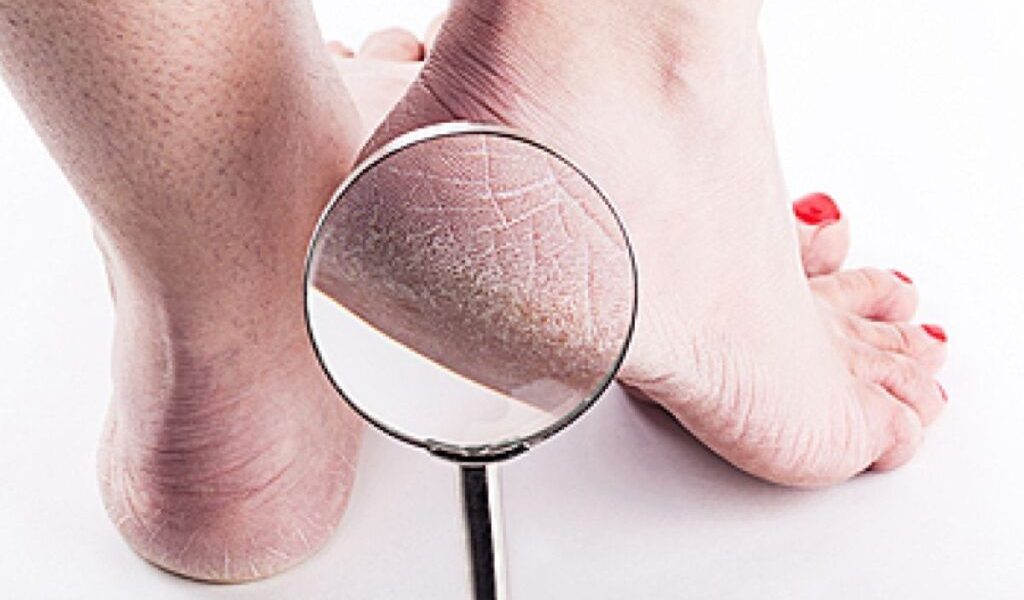 Culoarea călcâielor, semn de boală gravă! Avertisment de la un medic