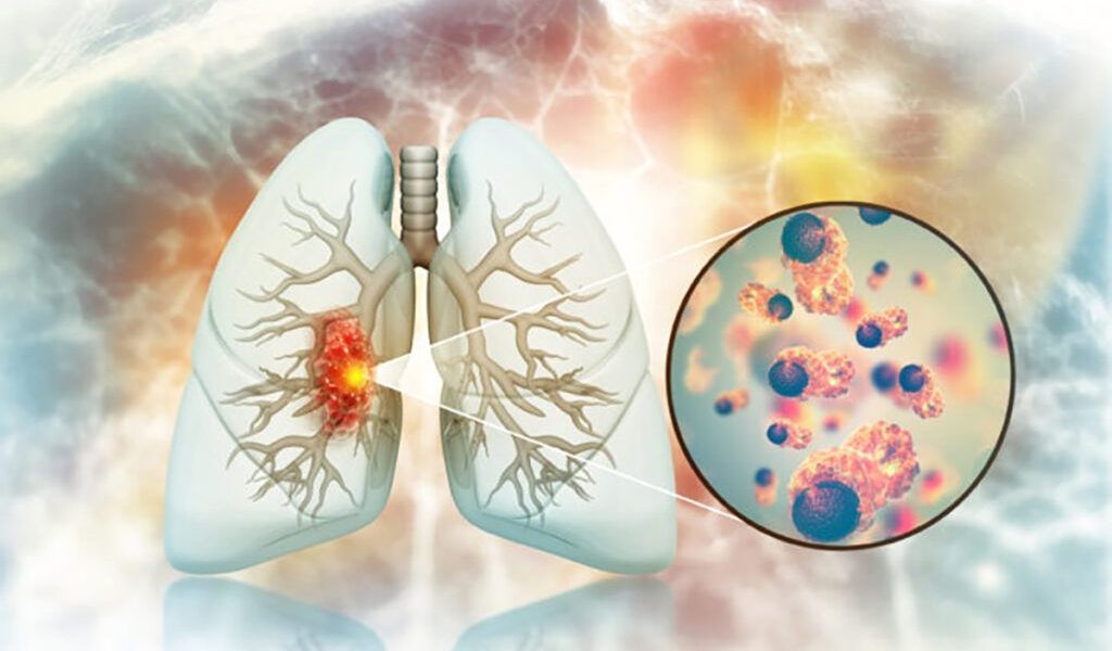 Cancer pulmonar la nefumători: medicii, uluiți de cauze