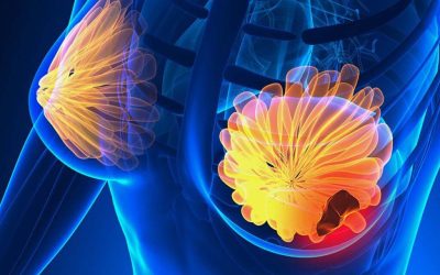 Semnele CÂȘTIGĂTOARE: Cum recunoști cancerul la sân. Fii ATENTĂ