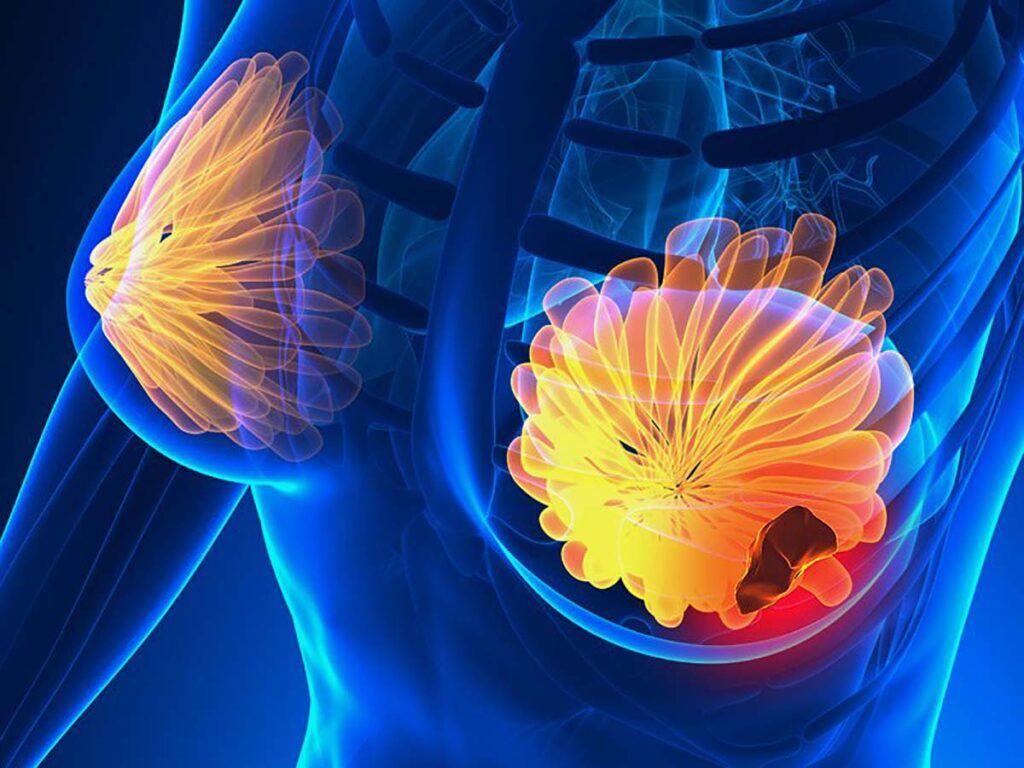 Semnele CÂȘTIGĂTOARE: Cum recunoști cancerul la sân. Fii ATENTĂ