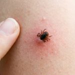 Evită țânțarii, căpușele și păianjenii: sfaturi de la medici.