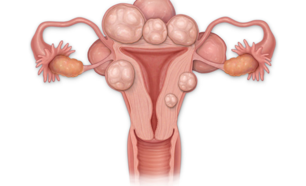 Fibromul uterin, o afecțiune frecventă la femeile aflate la vârsta reproductivă Fibromul uterin reprezintă una dintre cele mai comune leziuni benigne care apar în uterul femeilor active din punct de vedere reproductiv