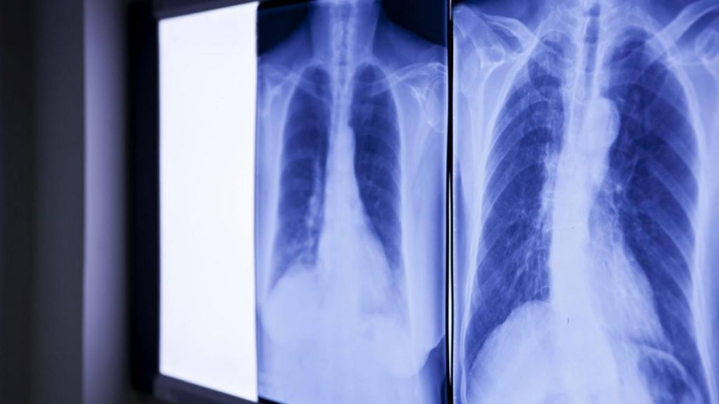 Medici ȘOCAȚI: Ce au găsit în abdomenul unui bărbat, vechi de PESTE 20 de ani