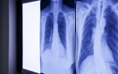 Medici ȘOCAȚI: Ce au găsit în abdomenul unui bărbat, vechi de PESTE 20 de ani