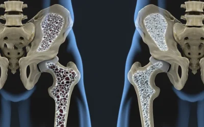 Nou tratament-minune: oase mai puternice și densitate refăcută, chiar și în osteoporoză