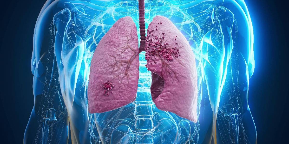 Medicii DEMONTEAZĂ miturile despre cancerul pulmonar: Adevărul crunt