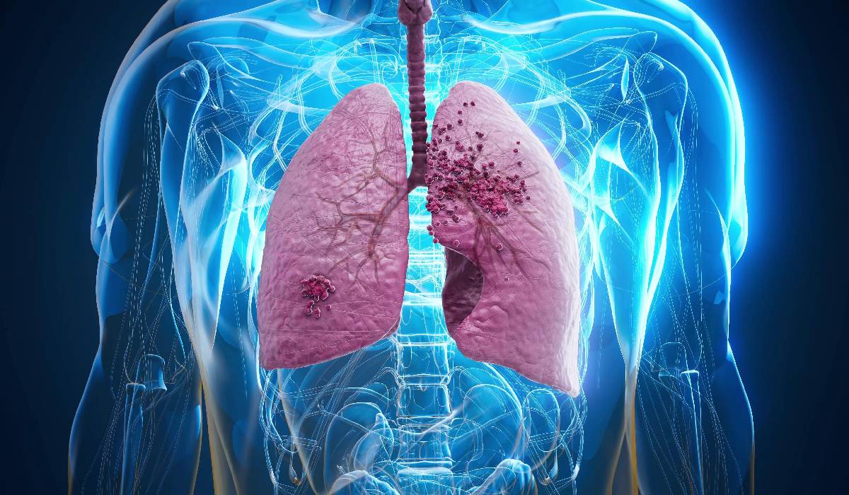 Cancerul pulmonar se menține ca o amenințare majoră la nivel global, fiind una dintre cele mai răspândite și, din păcate, letale forme de cancer