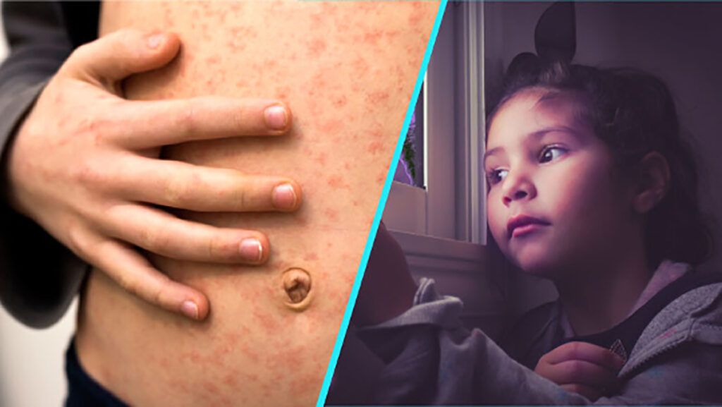 Rușinos: Dr. Alexiu: „Copii cu plămâni distruși, din cauza nevaccinării”