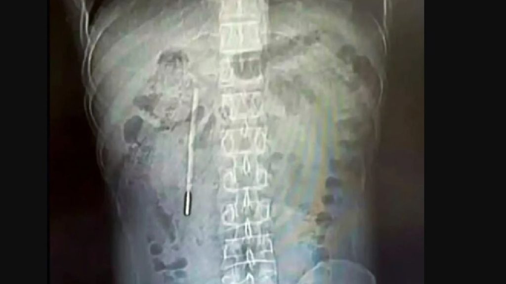 Medici șocați în China: Ce au găsit în stomacul unui pacient după 20 de ani!