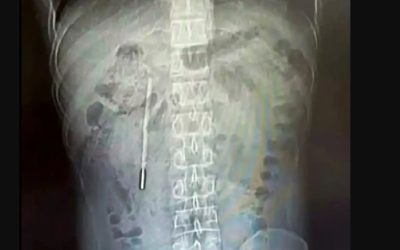 Medici șocați în China: Ce au găsit în stomacul unui pacient după 20 de ani!