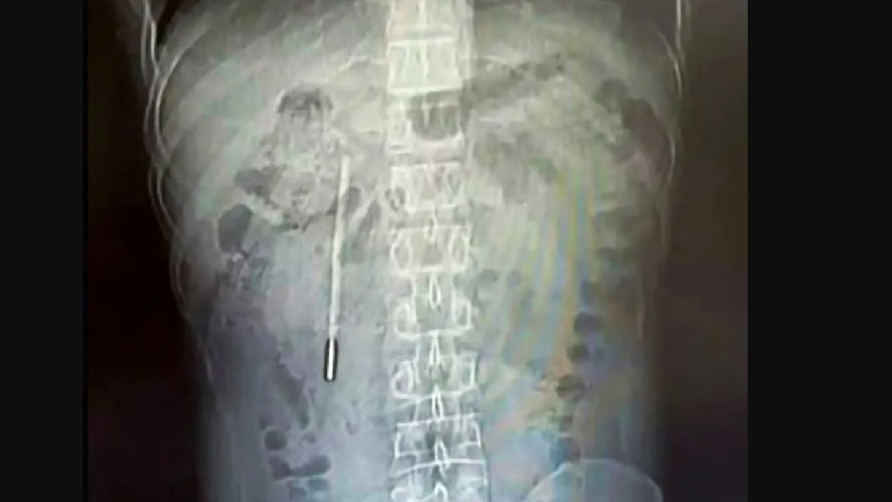 Medici șocați în China: Ce au găsit în stomacul unui pacient după 20 de ani!