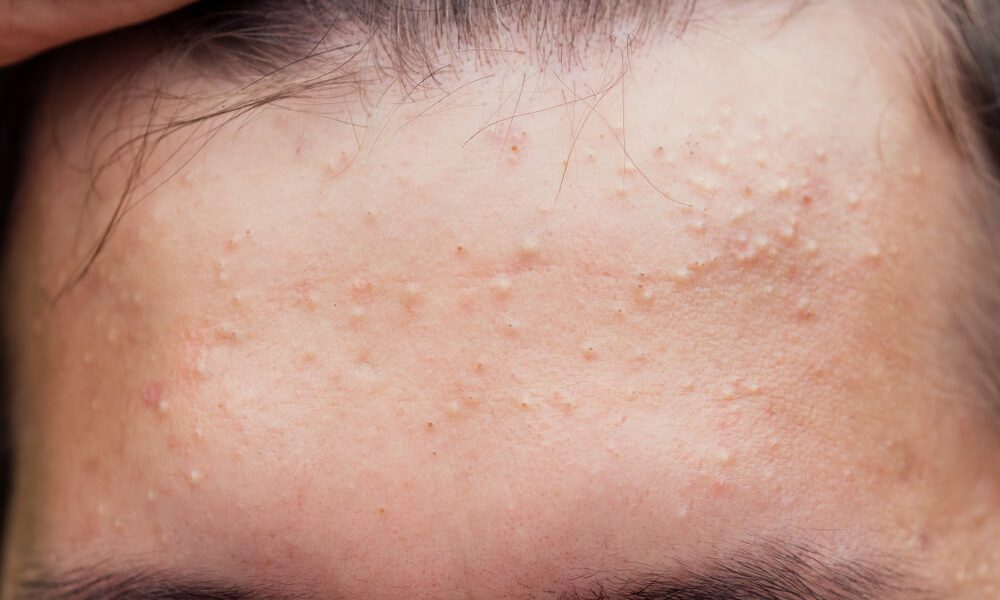 Acid salicilic: protocolul anti-acnee în 3 pași simpli, eficient și rapid