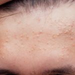 Acid salicilic: protocolul anti-acnee în 3 pași simpli, eficient și rapid