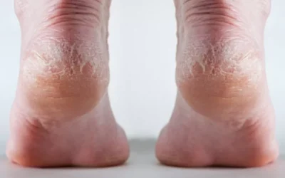 Culoarea călcâielor poate trăda boala de ficat. Avertisment de la un medic
