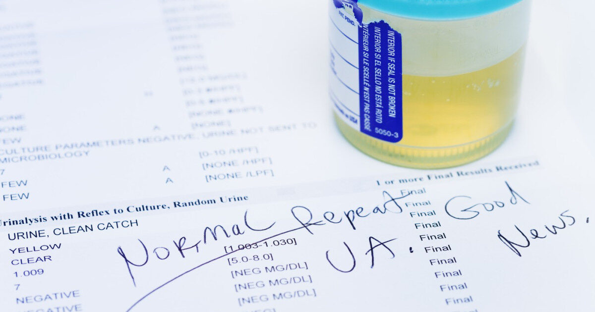Test urină: 9 din 10 cancere vezică depistate